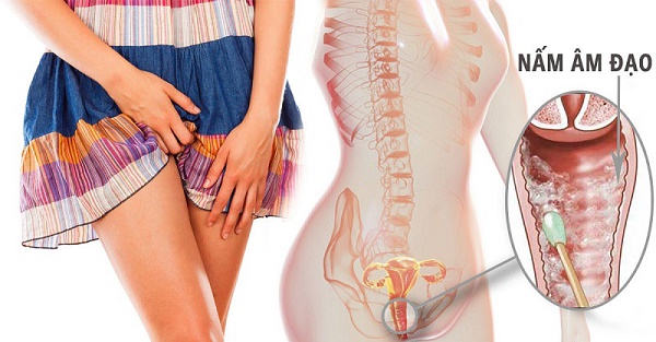 nâm âm đạo khi mang thai